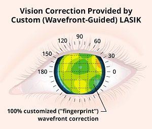 Wavefront Custom Lasik